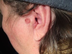 заболевание левой ушной раковины