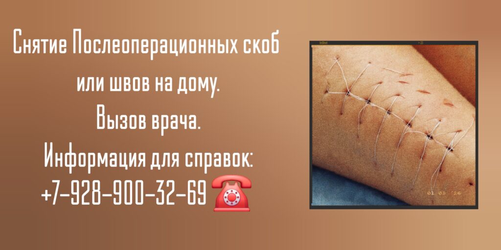 Снять скобы или швы на дому после операции Ростов-на-Дону 
