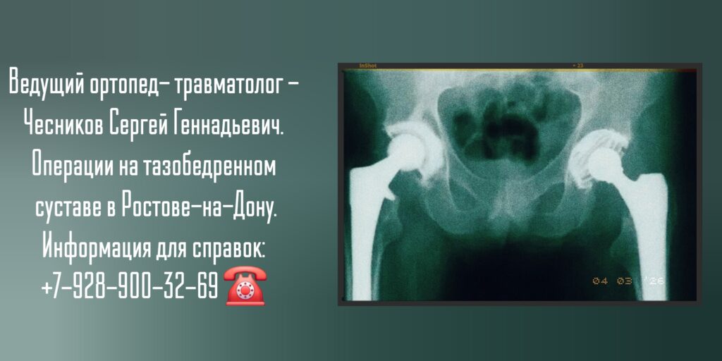 Чесников Сергей Геннадьевич - Тазобедренный сустав - травмы и заболевания Ростов-на-Дону 