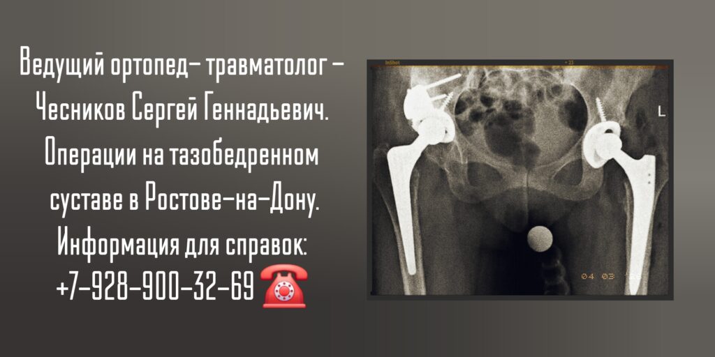 Чесников Сергей Геннадьевич - Тазобедренный сустав - травмы и заболевания Ростов-на-Дону 