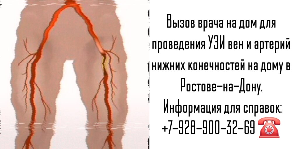 Вызов на дом врача в Ростове-на-Дону - УЗИ вен и артерий нижних конечностей