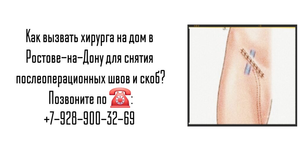 Снять послеоперационные скобы или швы на дому Ростов-на-Дону